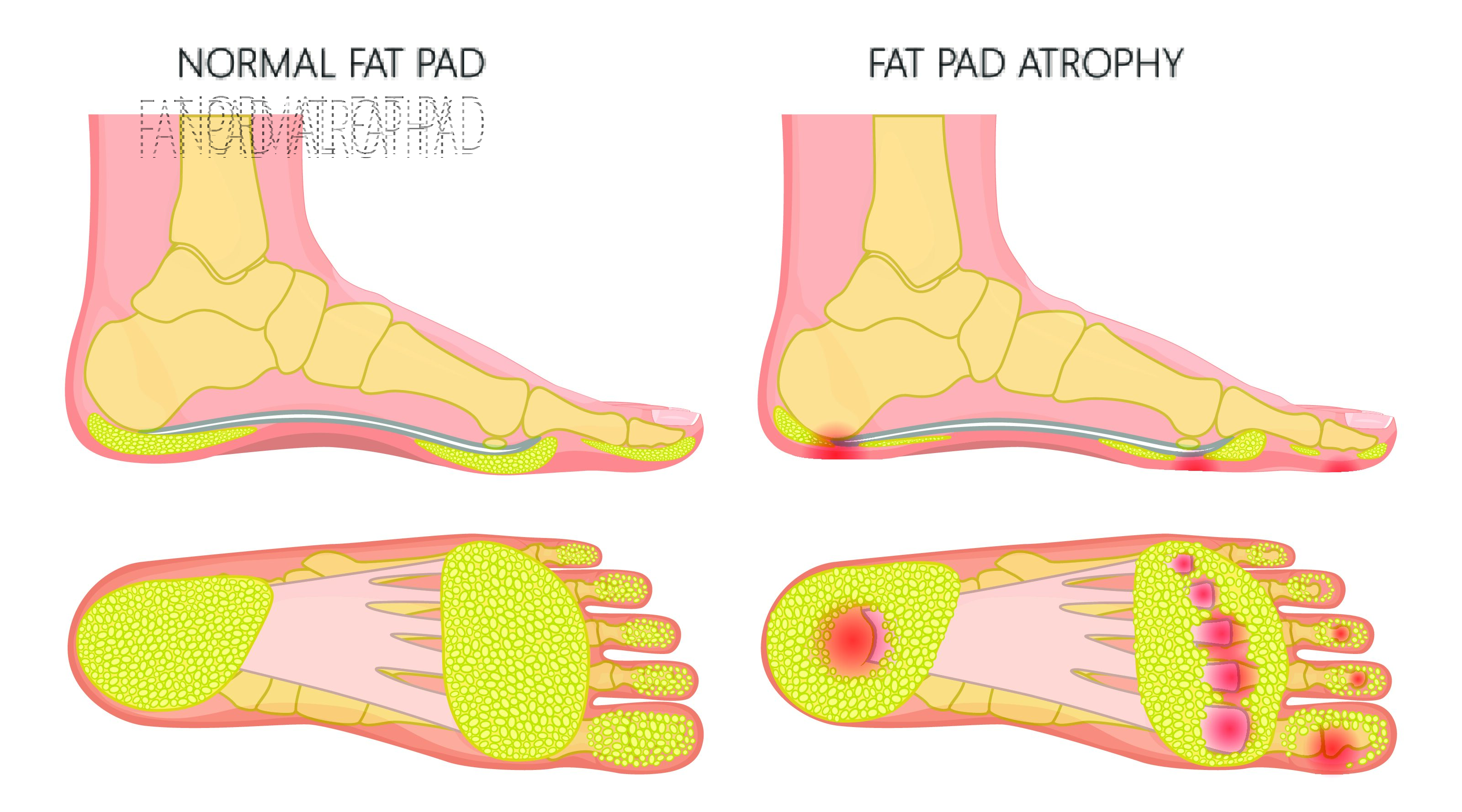 Fat Pad Atrophy Treatment - Foot, Ankle & Leg Vein Center