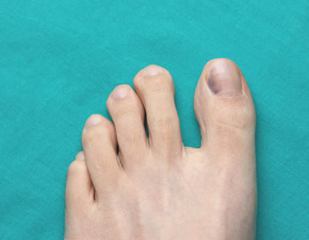 Everything You Need to Know About Bruised Toenails | #1 Rated Podiatrist