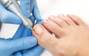 ingrown toenail