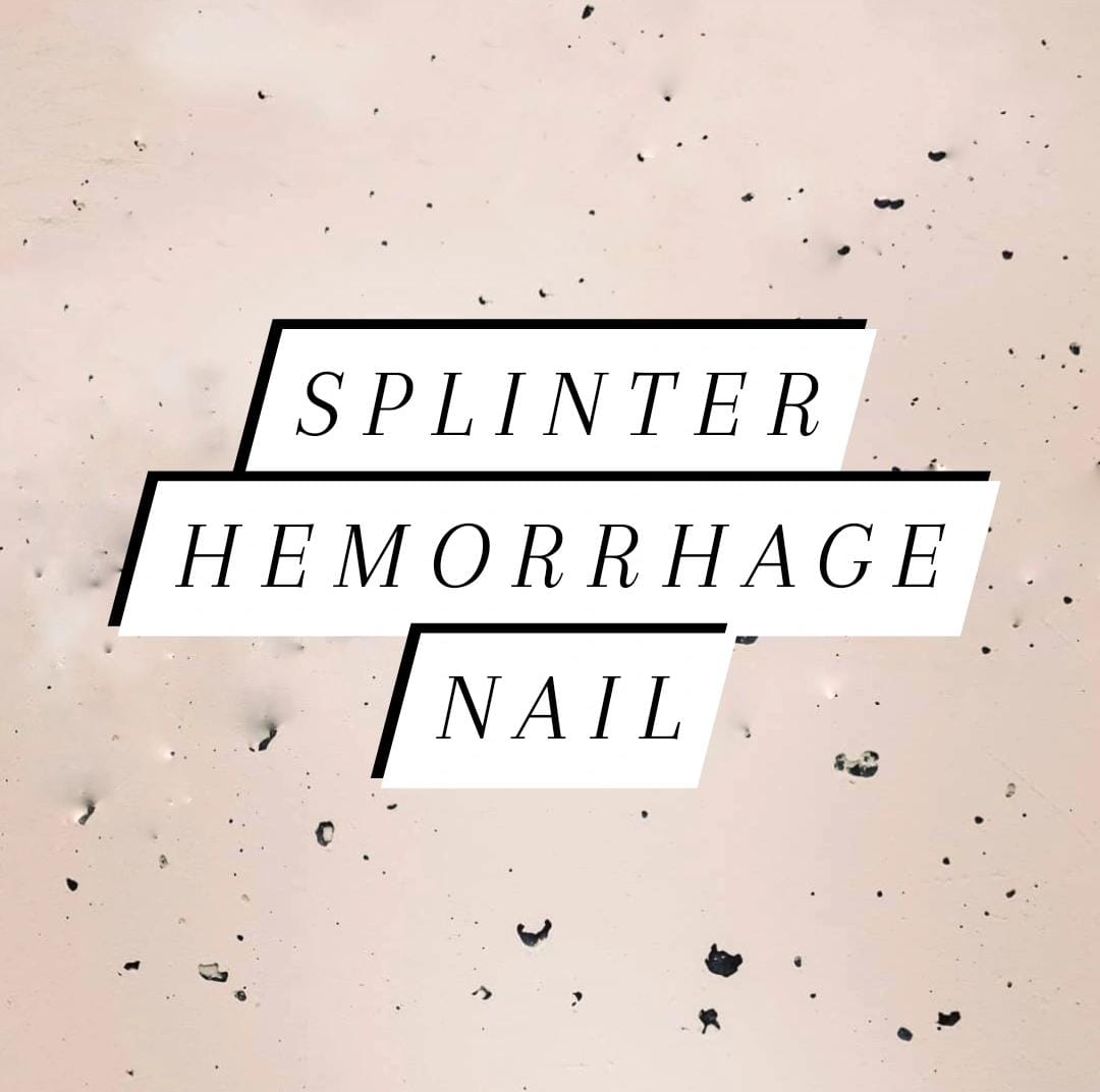 Splinter hemorrhages hi-res stock photography and images - Alamy
