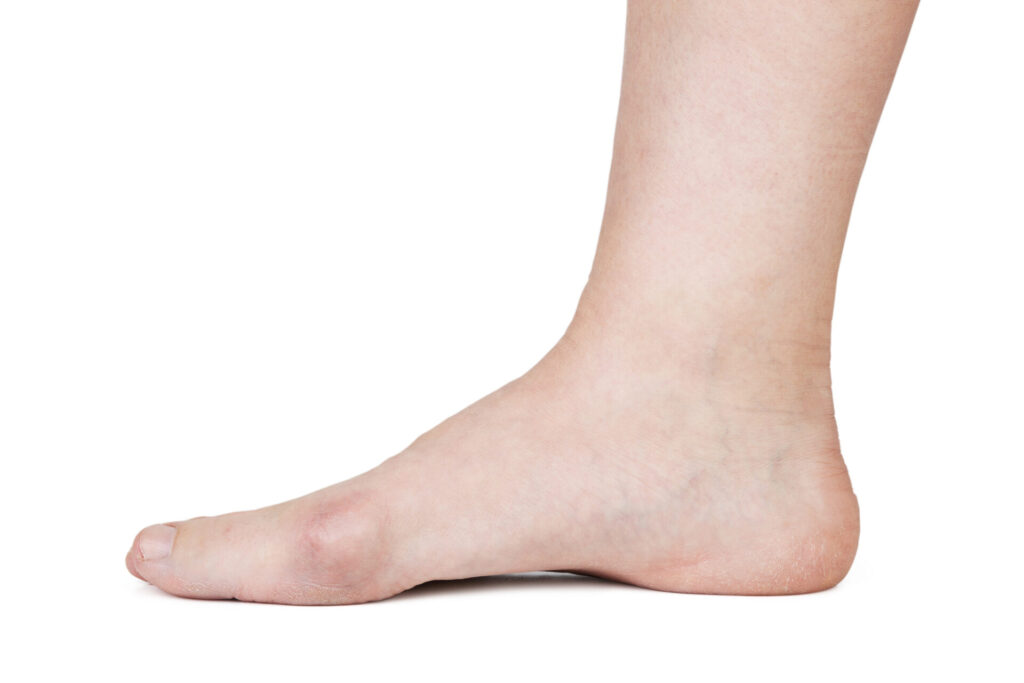 Hallux valgus interphalangeus (HVI)